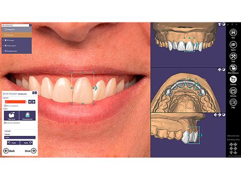 Exocad Smile Creator Module Gold Quadrat Dental