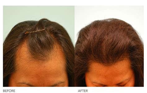 Female Hairline Lowering | Lam Institute for Hair Restoration