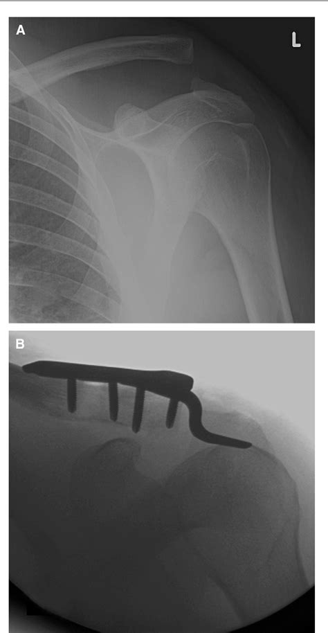 Figure From Transacromial Erosion Of A Locked Subacromial Hook Plate