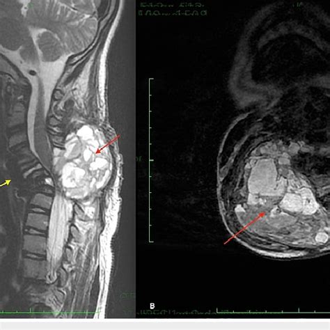 Sagittal A And Axial B Mri Showing Posterior Tumor Growth With Download Scientific Diagram