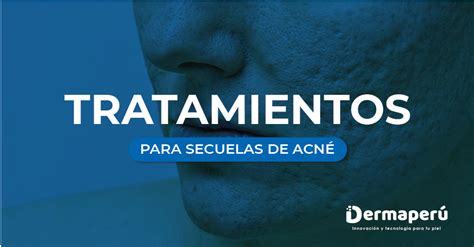 TRATAMIENTOS PARA LAS CICATRICES DE ACNÉ Dermaperu