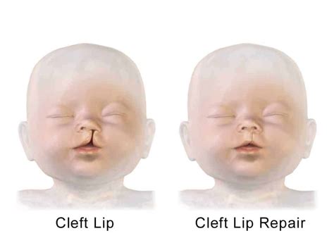 Cleft Lip and Palate – causes, symptoms, treatment, prognosis – Costamedic