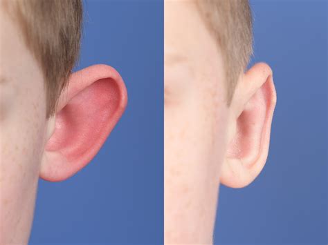 Otoplasty Denver Co Ear Surgery Lone Tree