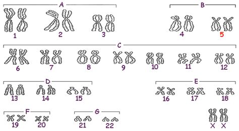 5p Syndrome