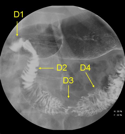 Duodenal Diverticula Potential Complications And Common Imaging