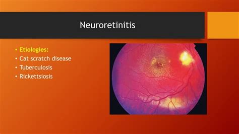 Approach To Posterior Uveitis Final Modified Ppt