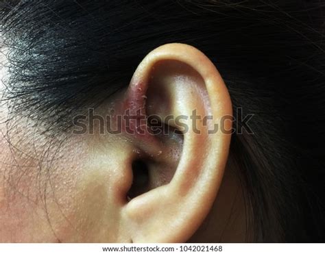 Seborrheic Dermatitis Ear