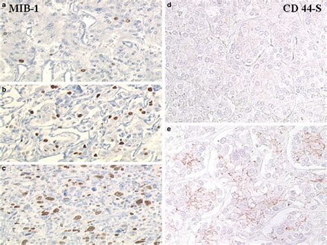 Cgh And Cd Mib Immunohistochemistry Are Helpful To Distinguish