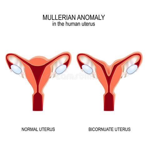 Set Of Uterine Septum Septate Uterus Normal And With Disease Female