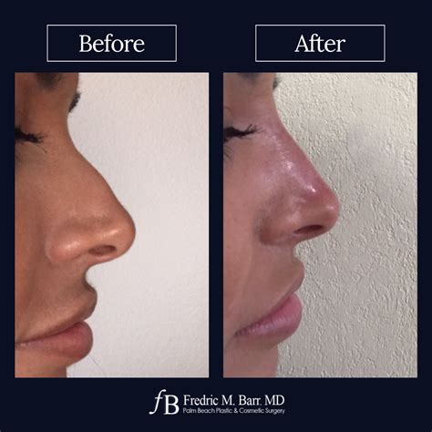 Derma Filler Palm Beach Plastic Cosmetic Surgery