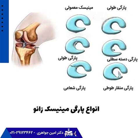 انواع آسیب های مینیسک زانو و اهمیت آن دکتر امین جواهری