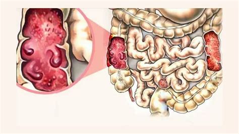 What Is Gastrointestinal Tuberculosis And What Are Its Symptoms