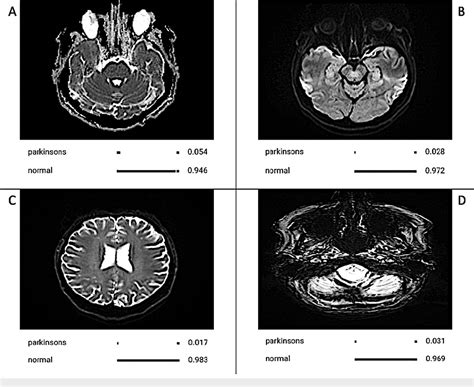 Figure 2 From Artificial Intelligence Diagnosis Of Parkinsons Disease From Mri Scans Semantic