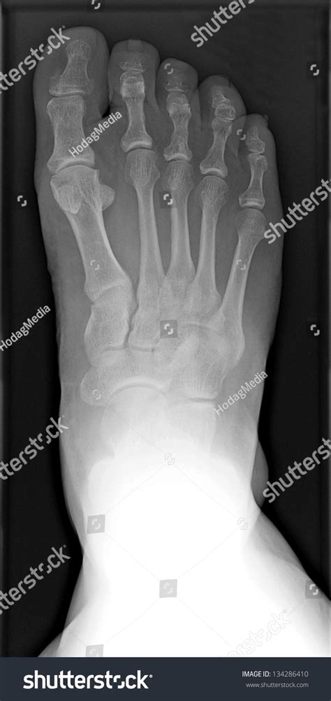 Male X Ray Of A Fractured Right Foot Senior Injury And Bone Spur On Big