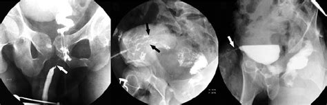 Left Ascending Urethrography Shows Bulbomembranous Stricture Arrow