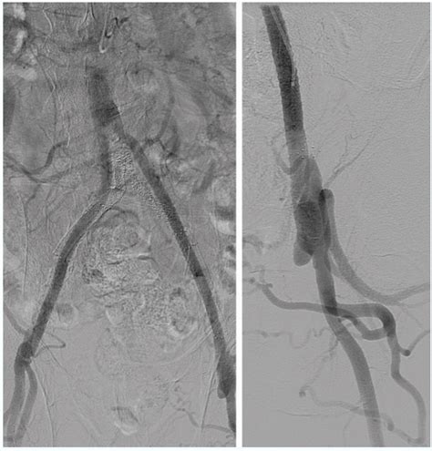 Femoral Artery Stent