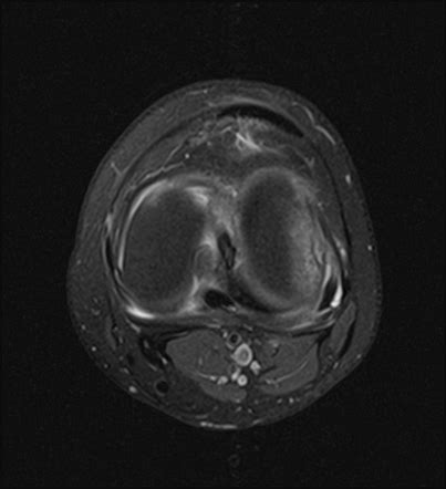 Transient Lateral Patellar Dislocation Image Radiopaedia Org