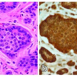 Histologic Analysis And Immunohistochemistry Well Differentiated