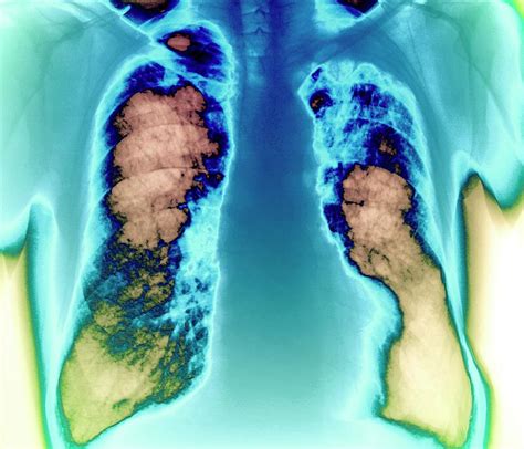 Lung Cancer 2 By Zephyr Science Photo Library