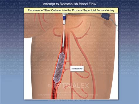 Femoral Artery Stent