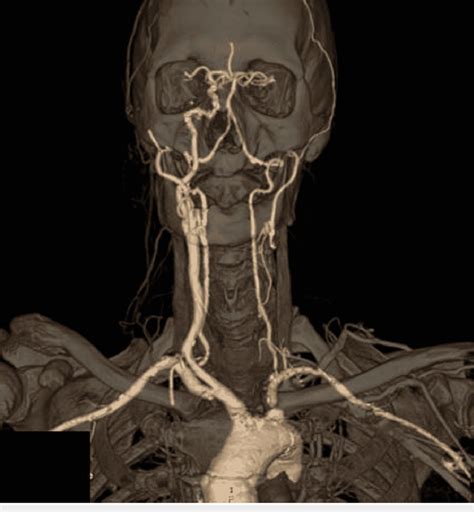 3d Head And Neck Cta Reconstruction Anterior View Download Scientific Diagram