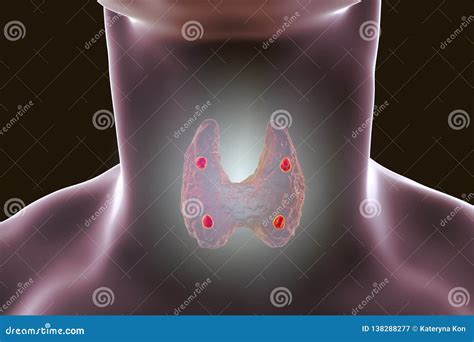 Parathyroid Glands Anatomy Royalty Free Cartoon Cartoondealer