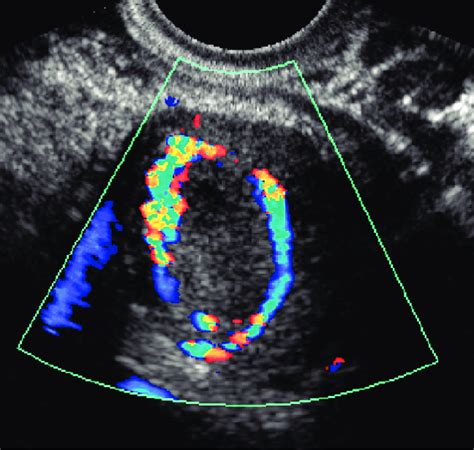 Color Doppler Image Of The Right Ovary Demonstrates The Typical Ring