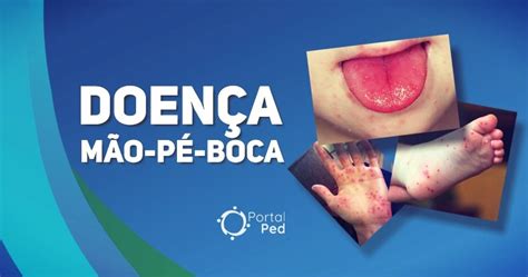 Doenca Mao Pe Boca Pediatria Sintomas Portalped Otosection