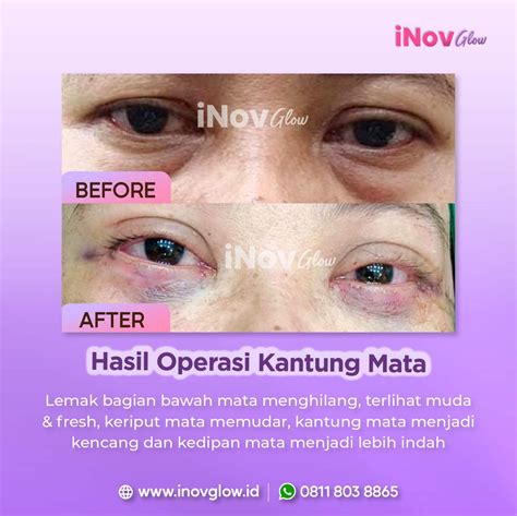 BEFORE AFTER OPERASI KANTUNG MATA INOVGLOW KLINIK SPESIALIS BEDAH