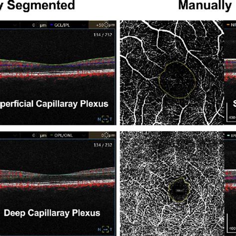 Optical Coherence Tomography Angiography Octa Images Of The