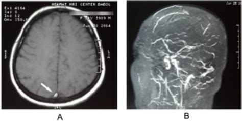 Trombose Venosa Cerebral Concise Medical Knowledge