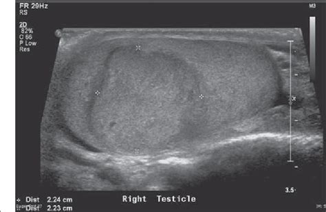 Figure 2 From Testicular Tumor Ultrasound Characteristics And