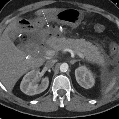 Ct Scan Performed Days After Surgery Axial Late Arterial Phase