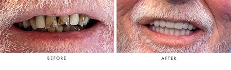 Before & After Photos | Winter Haven Dental | Winter Haven, FL