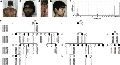 Phenotypes And Genetic Mapping Of Congenital Generalized Hypertrichosis