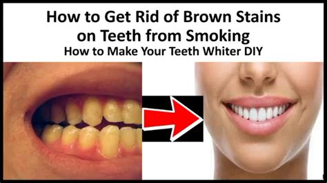 How To Get Rid Of Brown Stains On Teeth From Smoking How To Make Your