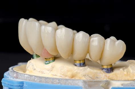 Implant-supported Full Arch Restorations | All-on-4, Teeth Tomorrow and ...