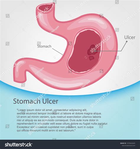 Cartoon Vector Illustration Of Stomach Ulcers Royalty Free Stock