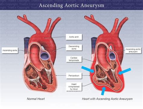 Ascending Aortic Aneurysm - TrialQuest Inc.