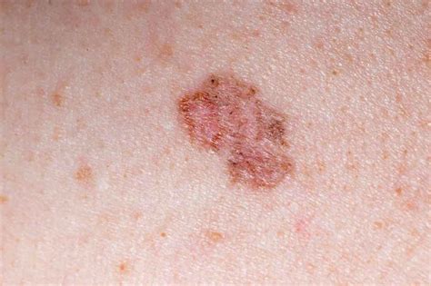 Carcinoma Basocellulare Il Tumore Della Pelle Pi Comune