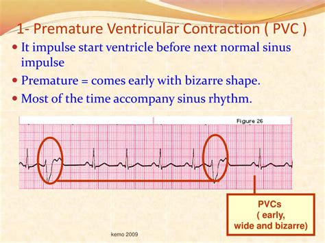 PPT Basic Dysrhythmia Recording ECG PowerPoint Presentation ID 1829175