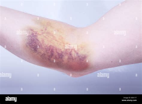 Hematoma Hi Res Stock Photography And Images Alamy