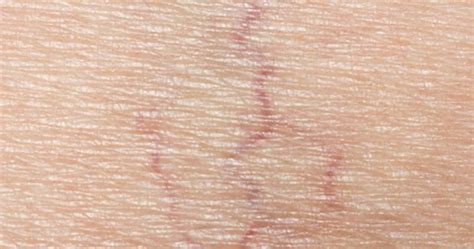 Common Causes Of Spider Veins On Face And Natural Treatment Tips