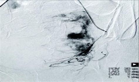 & 2 below shows about pre and post embolization impact of the procedure. | Download Scientific ...