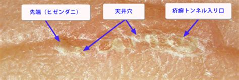 疥癬トンネルとは何か つねぴーblog＠内科専門医