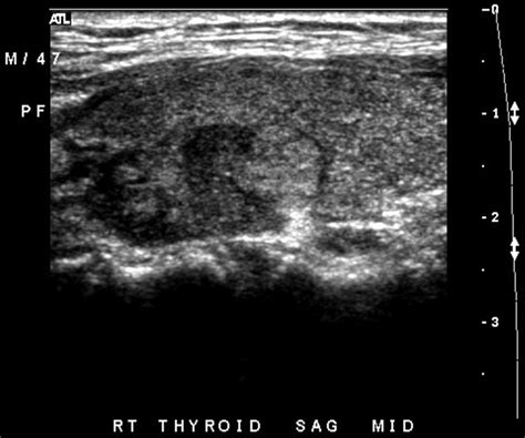 Thyroid Pathology Ultrasound