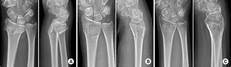 Successful Conservative Treatment Of A Displaced Distal Radius Fracture