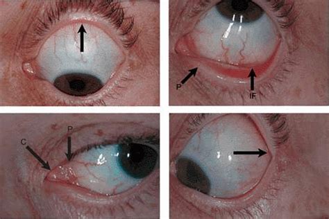 Fornix Eye Anatomy