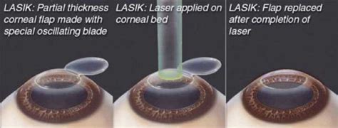 Laser Assisted In Situ Keratomileusis