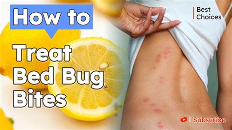 12 Easy Steps To Treat Bed Bug Bites How To Treat Bed Bug Bites Best Choices Youtube